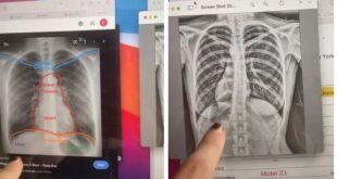 أمريكية تكتشف وجود قلبها بالجانب الأيمن من صدرها بالصدفة