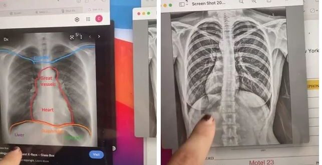 أمريكية تكتشف وجود قلبها بالجانب الأيمن من صدرها بالصدفة