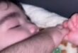 حالة نادرة لرضيع أمريكى يغطي الشعر جسمه بسبب عقار طبى