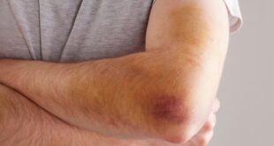 للتخلص من الكدمات.. 5 علاجات منزلية تساعدك