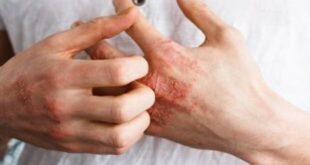 قبل فصل الشتاء ..4 نصائح طبية لمنع الإكزيما وحماية الجلد من الالتهاب