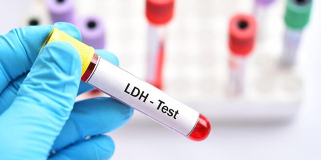 ما هو اختبار 'LDH'؟.. كل ما تريد معرفته