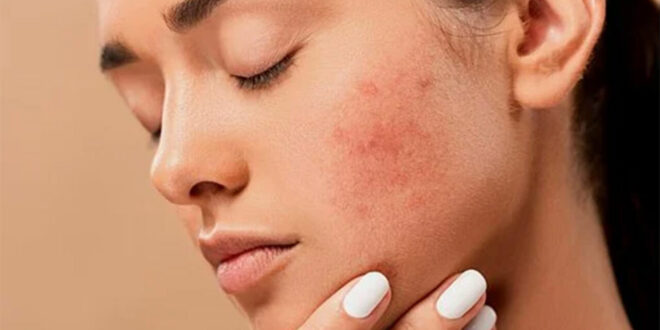 وصفات طبيعية للتخلص من ندبات الوجه والحصول على بشرة صافية