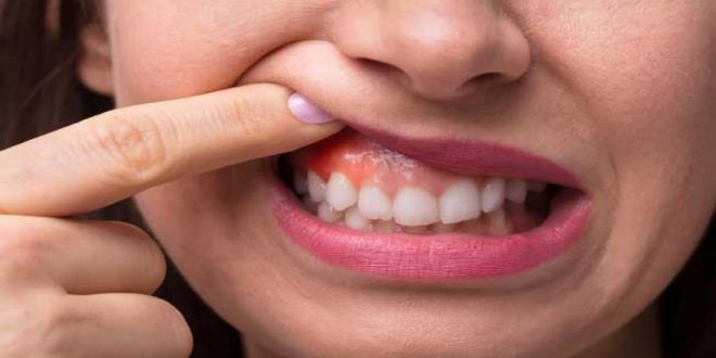أمراض اللثة تزيد خطر الإصابة بأمراض القلب والأوعية الدموية