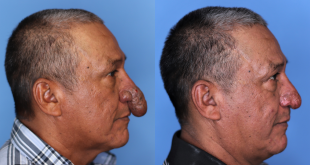 أمريكى يخضع لعملية تجميل لأنفه الأغرب فى العالم طوله وصل لشفتيه