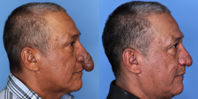 أمريكى يخضع لعملية تجميل لأنفه الأغرب فى العالم طوله وصل لشفتيه
