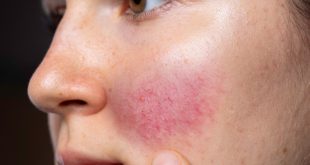 أسباب احمرار الخدود المفاجئ.. خجل أم مشكلة صحية؟