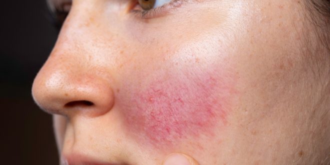 أسباب احمرار الخدود المفاجئ.. خجل أم مشكلة صحية؟