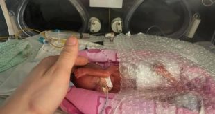 أصغر مولودة في بريطانيا تعيش على كف والدتها! بوزن 325 جرامًا