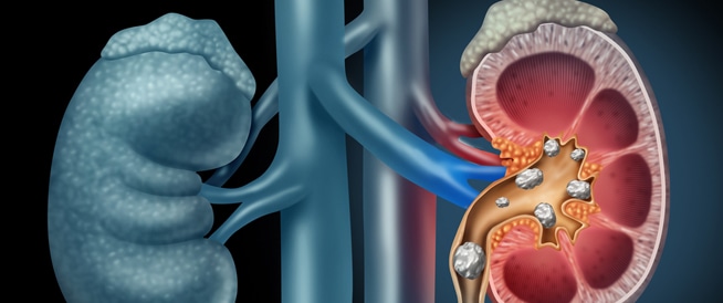 الكرياتينين- إليك المعدل الطبيعي في الجسم وأهميته للكلى