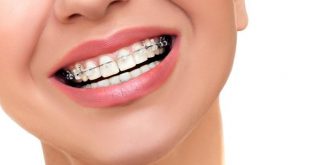 ما هي أنواع تقويم الأسنان والحالات التي تحتاجه؟