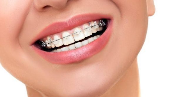 ما هي أنواع تقويم الأسنان والحالات التي تحتاجه؟