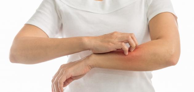 تعاني من الحكة المفاجئة أو ظهور الطفح الجلدي على جسمك؟ هذه الأطعمة قد تكون السبب