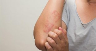 علامات منذرة على الهربس بعد كورونا