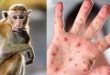 5 أشياء يجب أن تعرفها عن فيروس جدري القرود