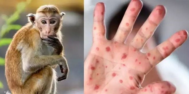 5 أشياء يجب أن تعرفها عن فيروس جدري القرود