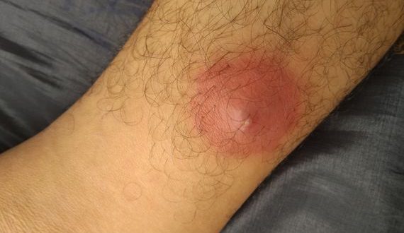 مؤلمة وقد تتحول إلى خرّاج أو تسبب التهابات شديدة.. أسباب ظهور الدمامل وطرق علاجها