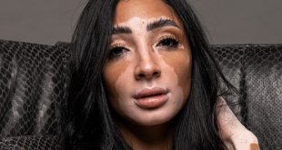 8 خرافات وحقائق شائعة عن البهاق