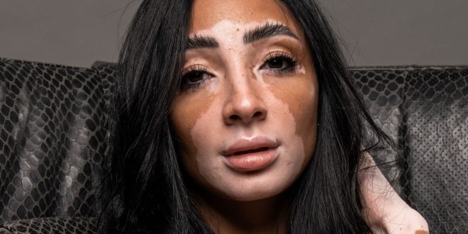 8 خرافات وحقائق شائعة عن البهاق