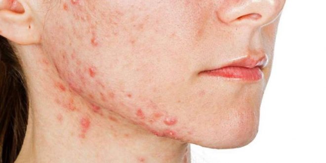 الزبادى يمكن أن يصنع المعجزات في علاج البثور الناتجة عن الالتهابات
