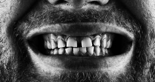 للأسنان بصمة مثل الأصابع.. كيف استطاعت الأسنان أن تحل أكثر الجرائم غموضاً؟
