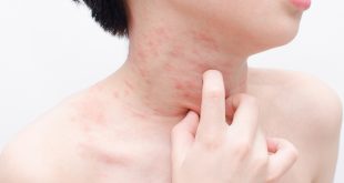 ما هى علامات وأعراض حساسية البنسلين؟