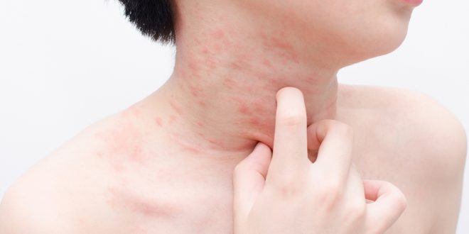 ما هى علامات وأعراض حساسية البنسلين؟