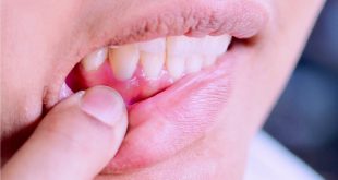 10 طرق لوقف نزيف معادن الأسنان.. تعرف عليها