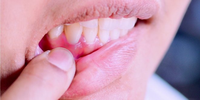 10 طرق لوقف نزيف معادن الأسنان.. تعرف عليها