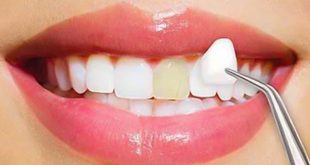 حلول وطرق مختلفة لعلاج مشاكل الأسنان .. أبرزها الفينير