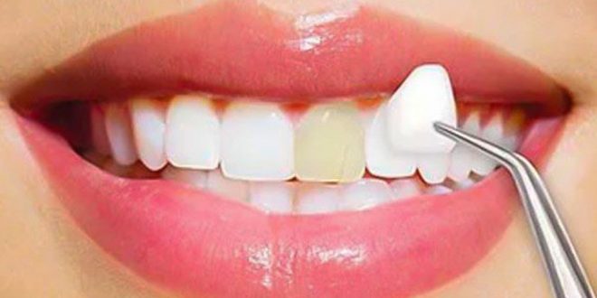 حلول وطرق مختلفة لعلاج مشاكل الأسنان .. أبرزها الفينير