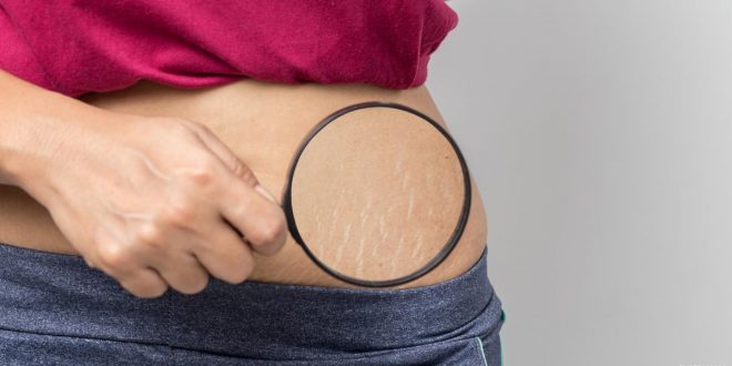 طرق مؤكدة للتخلص من الجلد المترهل وعلامات التمدد بعد الحمل