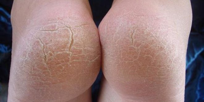 أمراض مزمنة والتهابات فطرية.. اعرفي أسباب تشقق القدمين وعلاجه