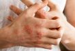 تعرف على أعراض الإكزيما وأسباب الإصابة بها