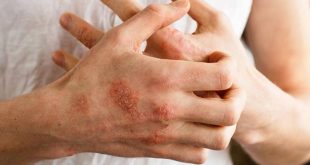 تعرف على أعراض الإكزيما وأسباب الإصابة بها