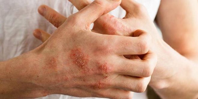 تعرف على أعراض الإكزيما وأسباب الإصابة بها