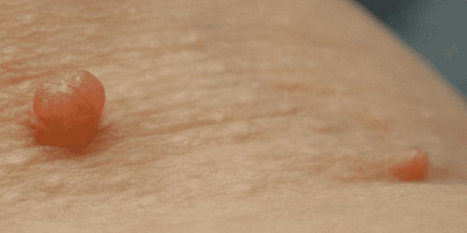لماذا تحدث الزوائد الجلدية وكيفية التخلص منها؟