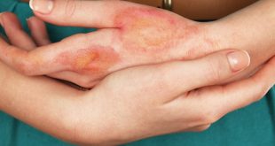 5 أخطاء شائعة في علاج الحروق.. منها وضع الثلج على الجرح