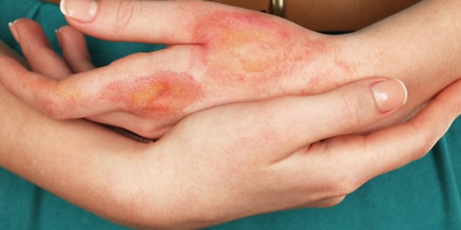 5 أخطاء شائعة في علاج الحروق.. منها وضع الثلج على الجرح