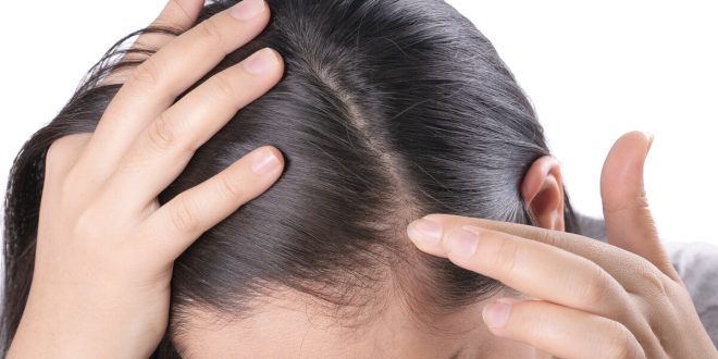 5 عادات غذائية سيئة تتسبب فى تساقط الشعر.. أبرزها نقص الحديد