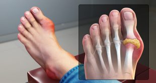 لمرضى النقرس.. طرق طبيعية للوقاية من نوبات الألم وخفض حمض اليوريك