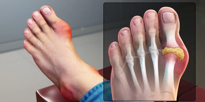 لمرضى النقرس.. طرق طبيعية للوقاية من نوبات الألم وخفض حمض اليوريك