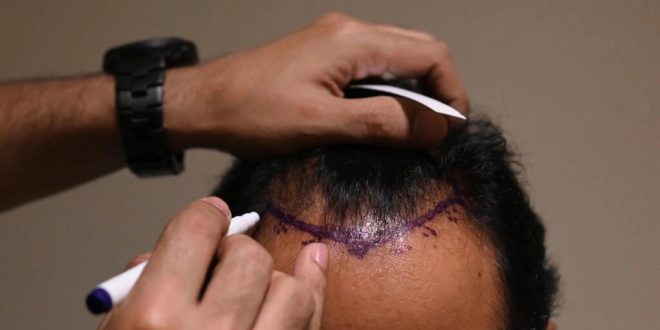 بسبب عملية زراعة شعر.. شاب هندى يدفع حياته ثمنًا فى رحلة البحث عن مظهر جذاب