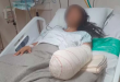 بتر يد سيدة برازيلية بعد الولادة بسبب خطأ طبى
