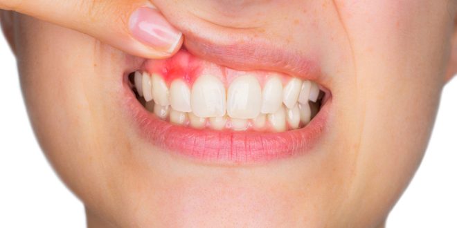إزاى تحافظ على اللثة من الانتفاخ والالتهاب؟