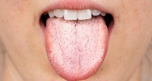 لماذا يصبح اللسان باللون الأبيض؟ طرق بسيطة لعلاجه