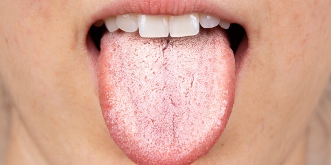 لماذا يصبح اللسان باللون الأبيض؟ طرق بسيطة لعلاجه