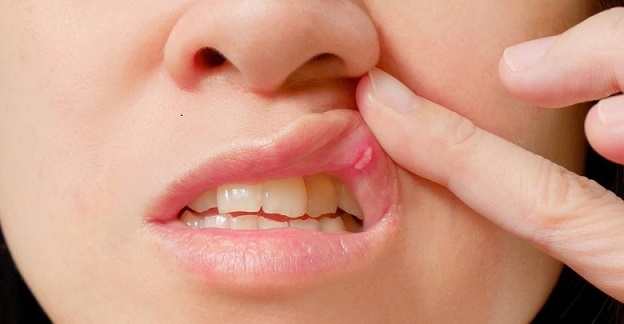 كل ما تحتاج معرفته عن قرحة الفم أسبابها وأعراضها وطرق علاجها