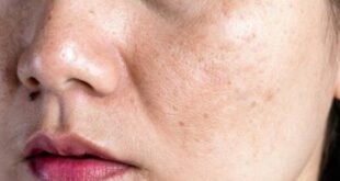 7 نصائح للتخلص من البثور العمياء والعناية بالبشرة