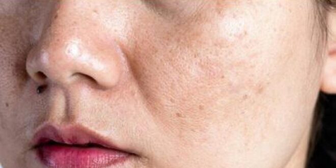7 نصائح للتخلص من البثور العمياء والعناية بالبشرة